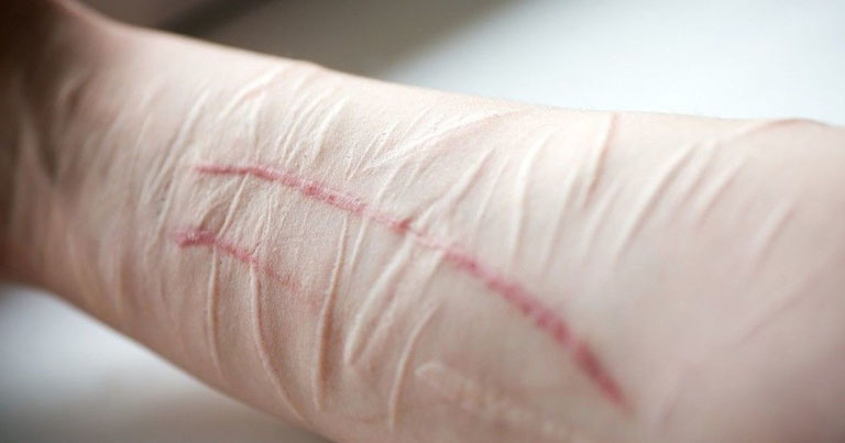 Tự hành hạ bản thân là bệnh gì Tự hành hạ bản thân là bệnh gì