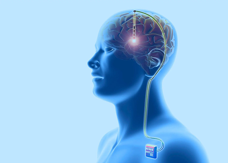 ưu nhược điểm của kích thích não sâu ưu nhược điểm của kích thích não sâu