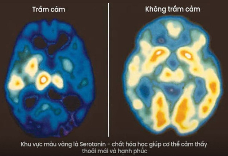 Não bộ có thể phục hồi sau trầm cảm không